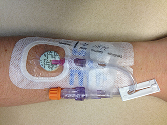 Peripheral IV catheter with intraluminal and extraluminal protection applied in conjunction with securement dressing. 
