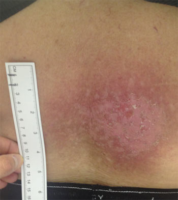 Figure 1: An example of main erythema 10 weeks after a hepatic embolization procedure. Mild hyperplasia is seen as the skin begins to repopulate. The peak skin dose was estimated to be 10 Gy for this case.